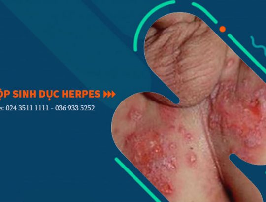 Chữa mụn rộp sinh dục HSV Herpes như thế nào là an toàn hiệu quả?