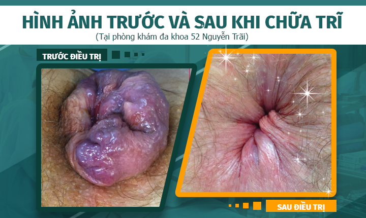 Hình ảnh trước và sau khi cắt trĩ tại phòng khám Đa khoa 52 Nguyễn Trãi