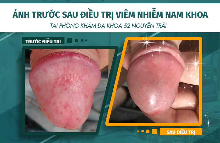 Hình ảnh trước và sau khi điều trị viêm nhiễm nam khoa tại phòng khám Đa khoa 52 Nguyễn Trãi