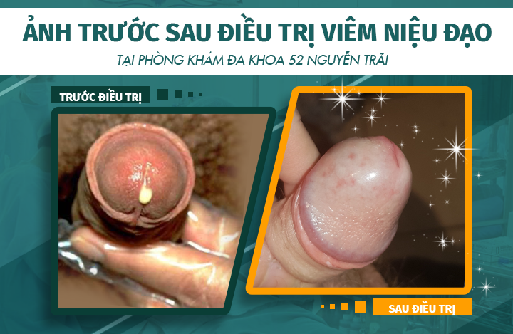Hình ảnh trước và sau khi điều trị viêm niệu đạo do quan hệ đồng tính nam tại phòng khám Đa khoa 52 Nguyễn Trãi