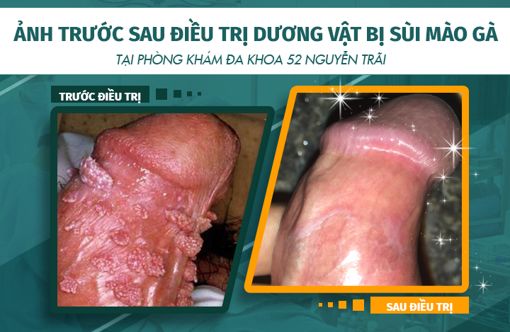 Hình ảnh trước và sau khi điều trị sùi mào gà do quan hệ đồng tính nam tại phòng khám Đa khoa 52 Nguyễn Trãi