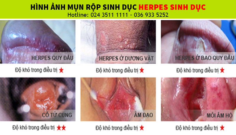 hình ảnh mụn rộp sinh dục HSV Herpes
