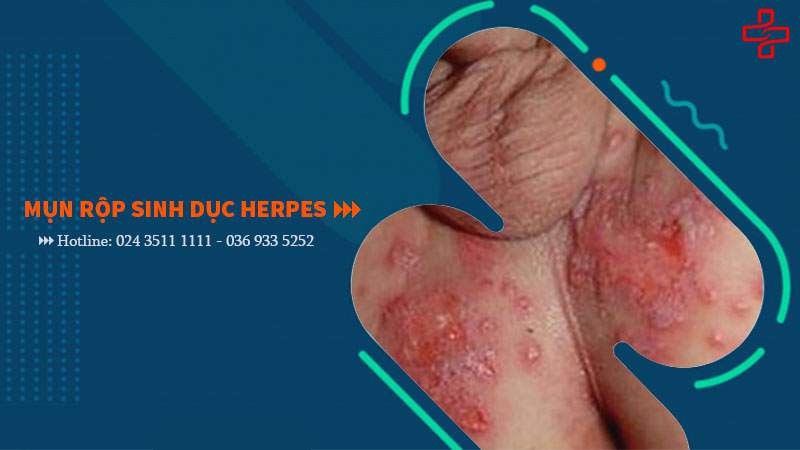Chữa mụn rộp sinh dục HSV Herpes như thế nào là an toàn hiệu quả?