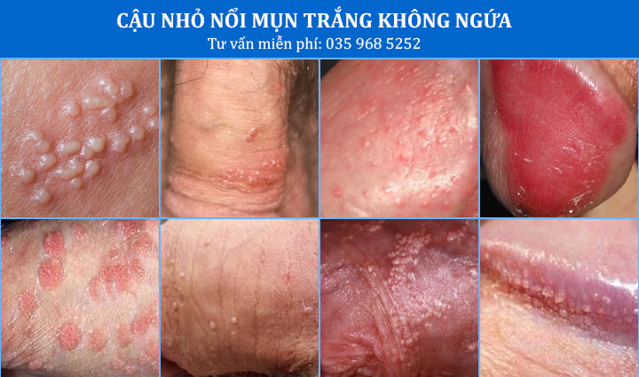 Vì sao nhiều nam giới lựa chọn phòng khám Đa khoa 52 Nguyễn Trãi trong điều trị cậu nhỏ nổi mụn trắng không ngứa?