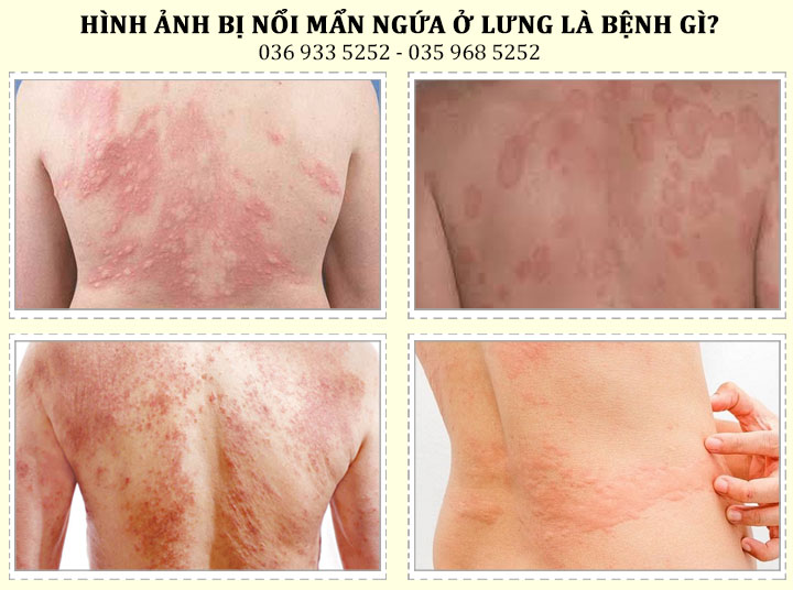 Bị nổi mẩn đỏ ngứa ở lưng là dấu hiệu của bệnh gì?