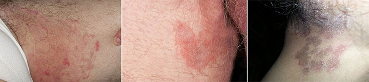 Cảnh giác với các bệnh lý có biểu hiện ngứa da vùng háng bẹn