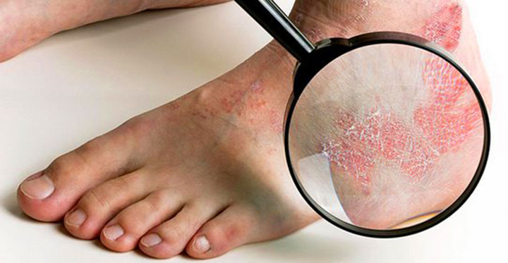 Bị ngứa nổi mụn nước mẩn đỏ ở da chân, kẽ chân là bệnh gì?